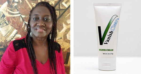 Editors note: Black Mom Solves Fungal Skin Infection Problem Called Tinea Versicolor